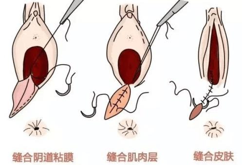 “会阴切侧”准妈妈应了解