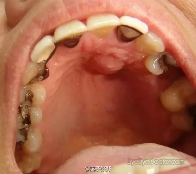 厉害了！她用缝衣针来治疗牙疼