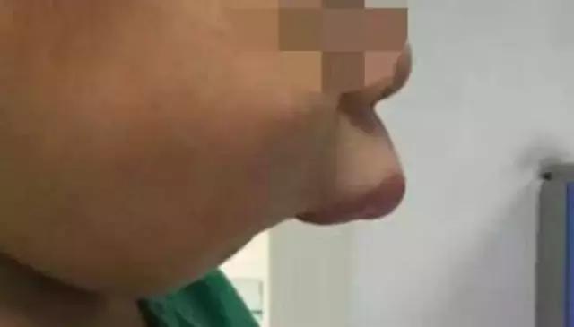 厉害了！她用缝衣针来治疗牙疼