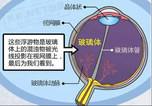 治疗玻璃体混浊的药,眼玻璃体混浊如何治疗