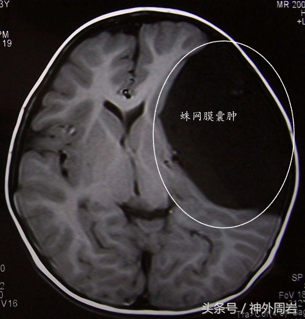 颅内蛛网膜囊肿有症状不及时治疗,颅内多发蛛网膜囊肿怎么治