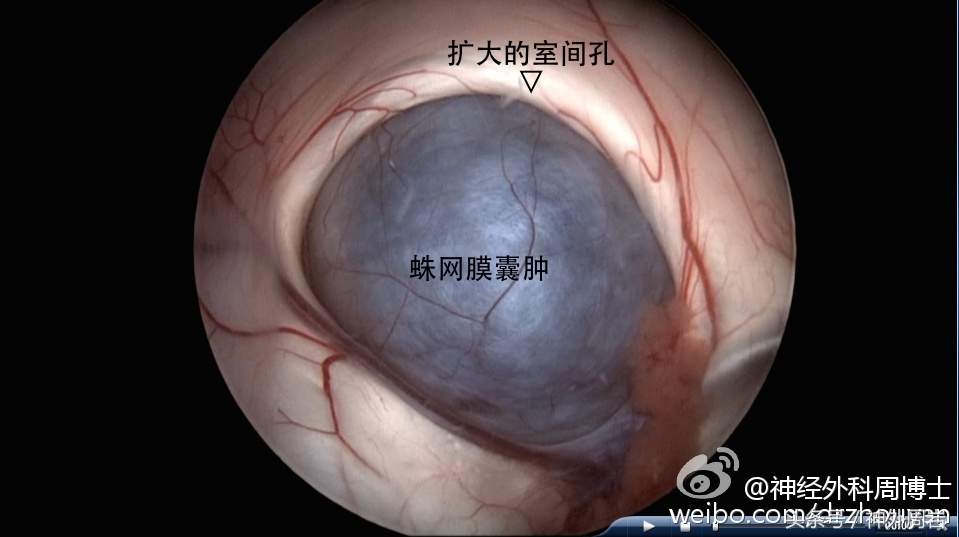 颅内蛛网膜囊肿有症状不及时治疗,颅内多发蛛网膜囊肿怎么治