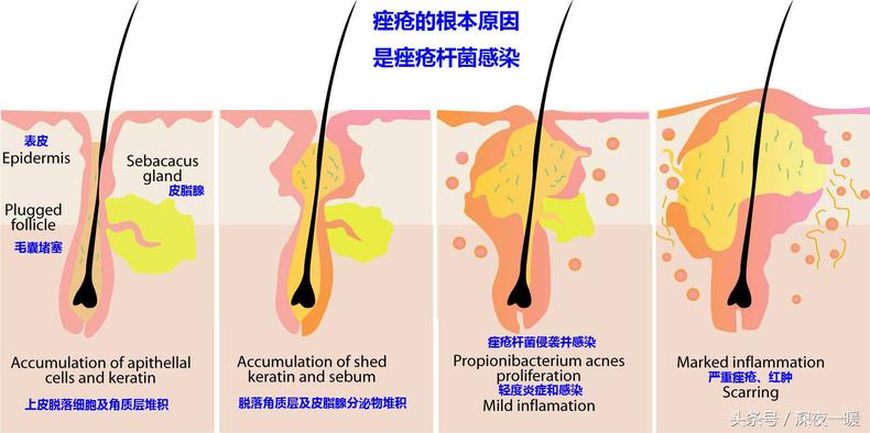 祛痘好方法更快更有效,祛痘最真实的方法
