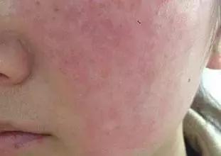抵抗力下降引起皮肤过敏怎样处理,皮肤过敏后脸部脱皮怎么处理