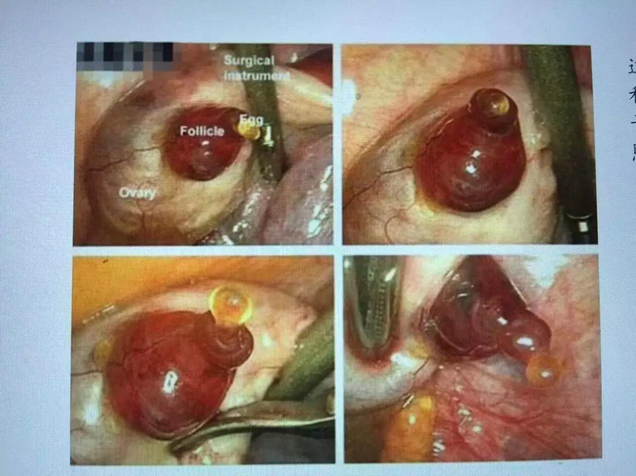 卵泡发育不良艾灸哪里,卵泡发育不良吃避孕药