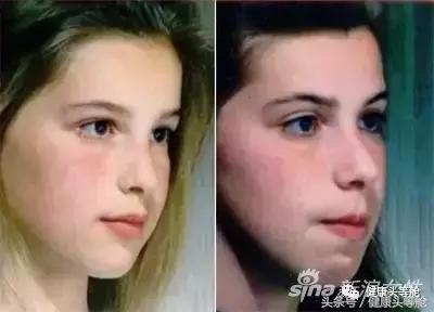 用嘴呼吸的对容貌的影响,用嘴呼吸会导致什么面容