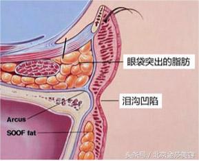 泪沟和眼袋有什么区分？预防及治疗方法有哪些？