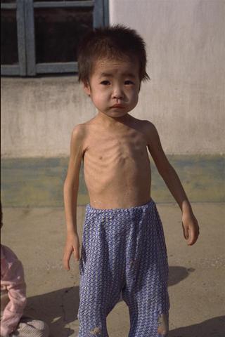 衰老的白发和少年白发有区分吗,现在的人年轻为什么这么早白发呢