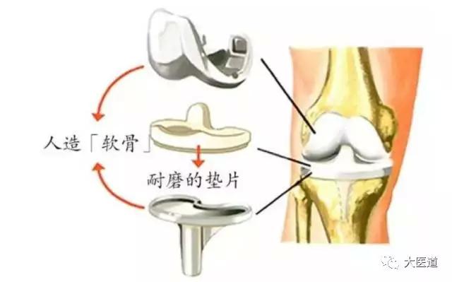 老人膝盖疼痛的原因和治疗方法,人未老腿膝盖疼怎么办