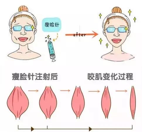 打瘦脸针与不打瘦脸针的区分,为什么打瘦脸针没有效果呢