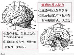 应对癫痫的正确做法,哪些做法能够减缓癫痫发作