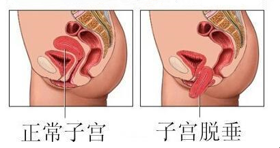 产后必读！常见病防治之子宫脱垂！