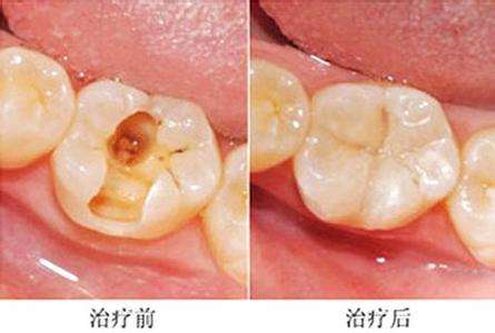补牙告知我们什么道理,补牙去医院怎么跟医生说