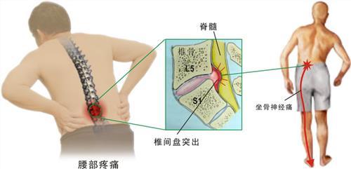 腰椎间盘突出的防治知识,健康养生知识腰椎间盘突出