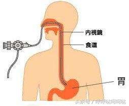做胃镜一般多少钱,杭州做胃镜一般要多少钱