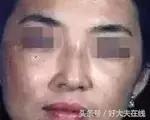 褐斑怎么治才能彻底消除,褐青色斑怎么治疗好