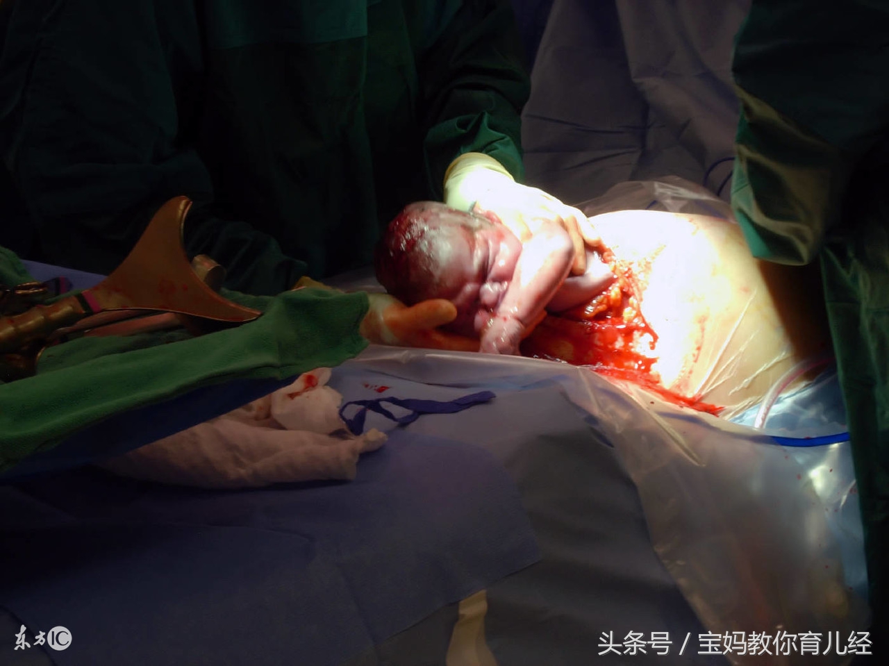 产妇子宫破裂一尸两命,子宫破裂致产妇死亡事件