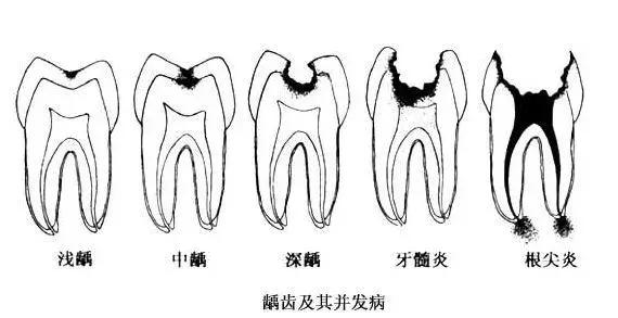牙齿掉了什么时候补牙最好,牙齿缺了一半补牙要多少钱