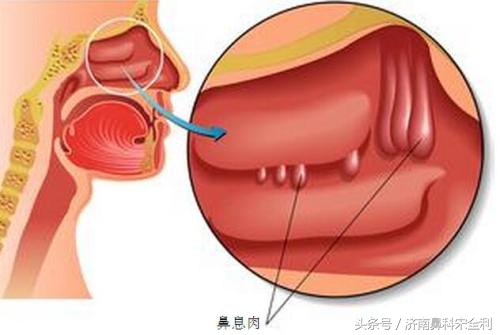 鼻息肉术后为什么会复发,鼻息肉手术后又复发了怎么处理