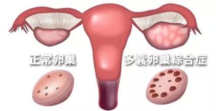 不孕黑手：多囊卵巢综合症