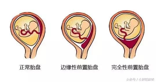 胎盘低置状态胎盘血池什么意思,胎盘不低胎位低怎么回事