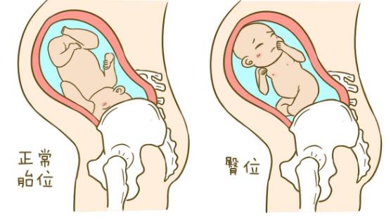 胎儿打嗝孕妈需求做什么,胎儿打嗝孕妈需求什么姿势