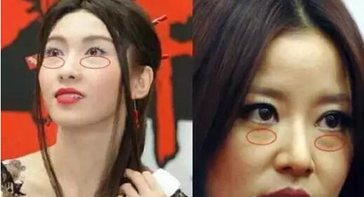 解决眼袋只需求三步,有眼袋不要慌用这个方法简单实用