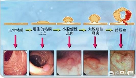 右肾15mm结节如何区分良性与恶性,4mm的实性结节怎样鉴别良性或恶性