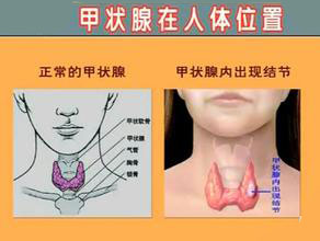 查乳腺为什么要查甲状腺,甲状腺乳腺科怎么检查