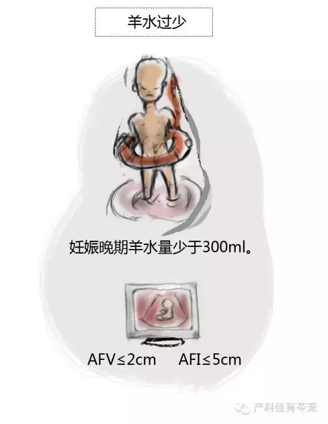 羊水过多和过少的原因,怎么预防羊水过多或过少