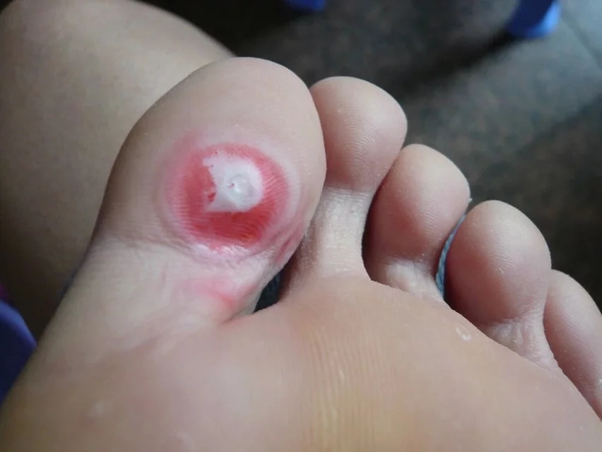 鸡眼病因,鸡眼发病原因与中医治疗