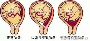 孕13周胎盘覆盖宫内口,13周下缘达宫颈内口危险吗