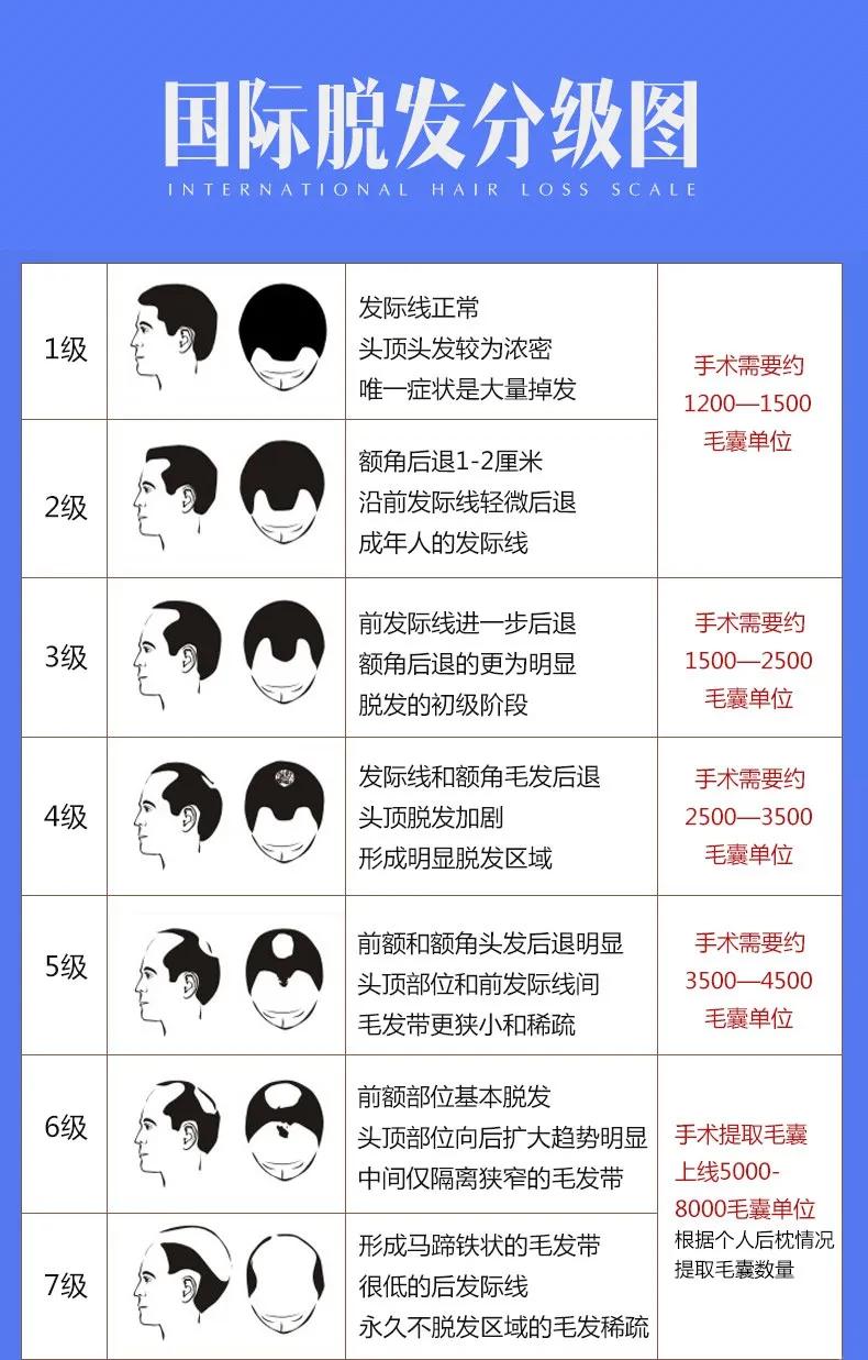 油腻脂溢性脱发,脂溢性脱发怎么抑制出油