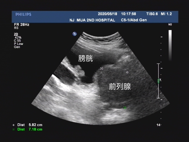 中医治疗前列腺增生什么药最有效,中医治疗前列腺增生多久能见效