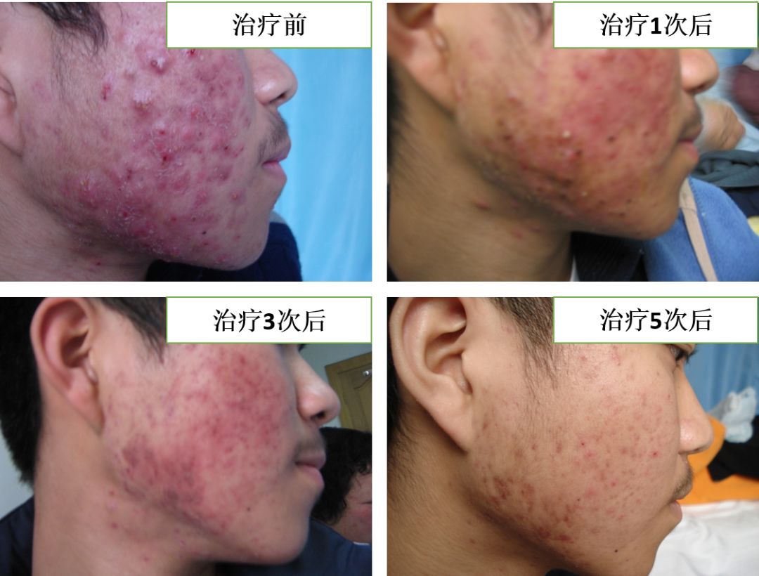 中医火针疗法教学视频,火针动手手法