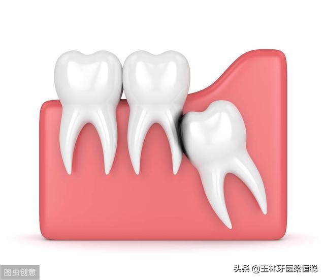 中医认为智齿需求拔除吗,正位智齿需求拔除吗