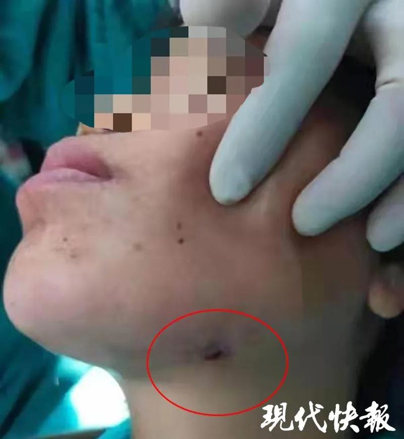 女子智齿烂脸,智齿发炎的真实案例