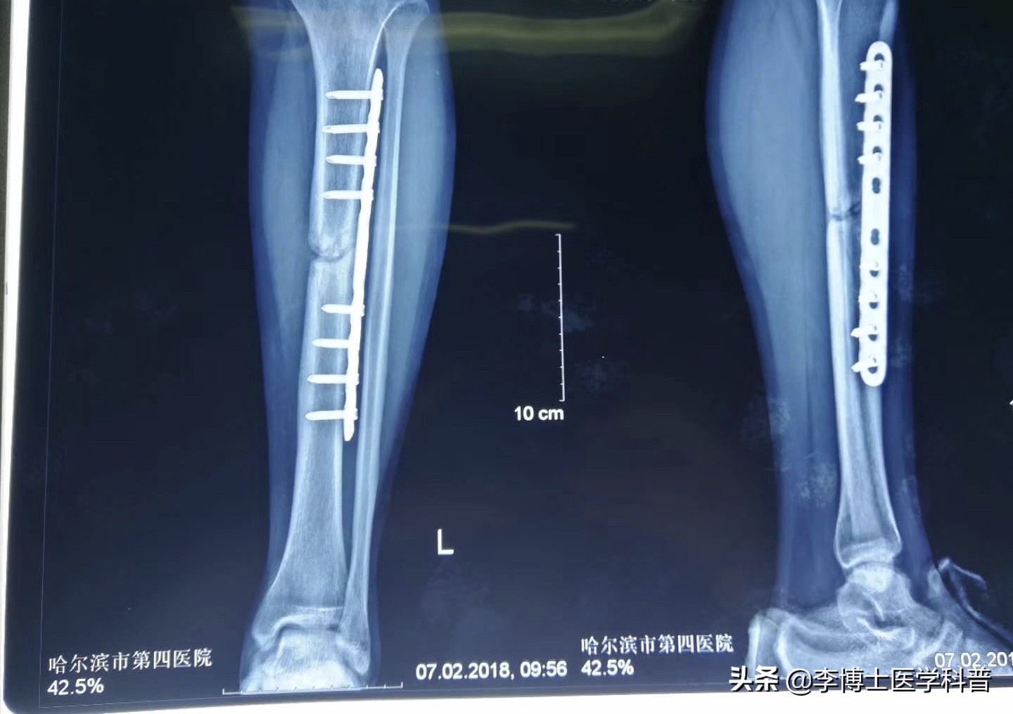 骨头摔折了3年没长上你说怎么办？其它方式不行，我们还有冲击波