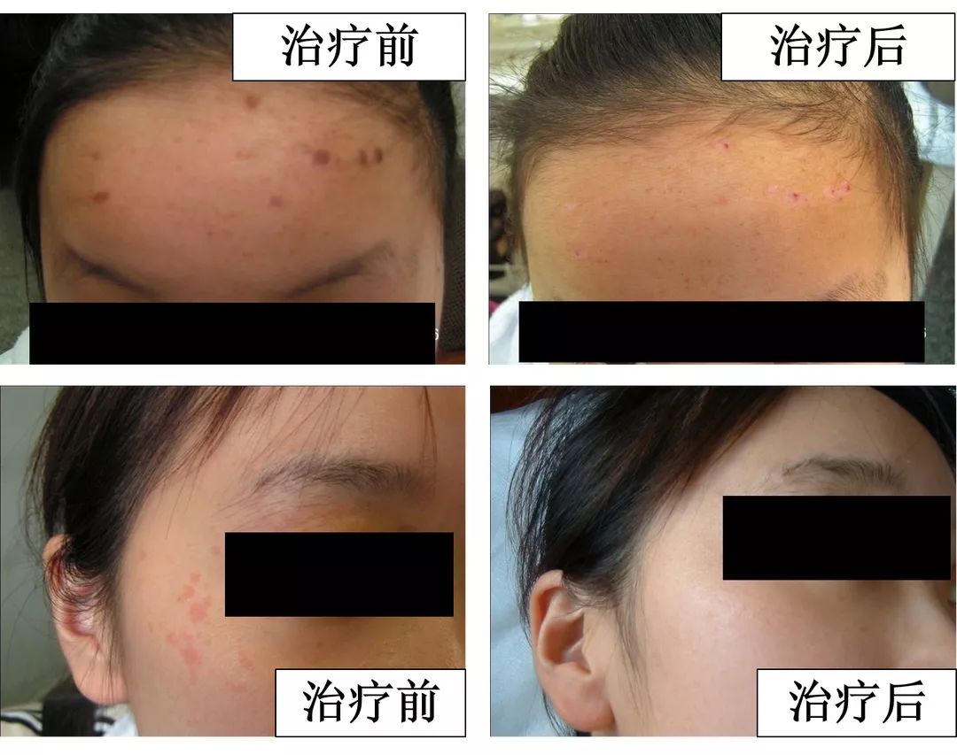 中医火针疗法教学视频,火针动手手法