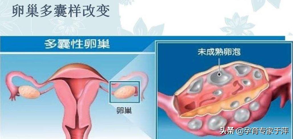 于萍：多囊卵巢综合征怎么治？看看这2个病例就知道了