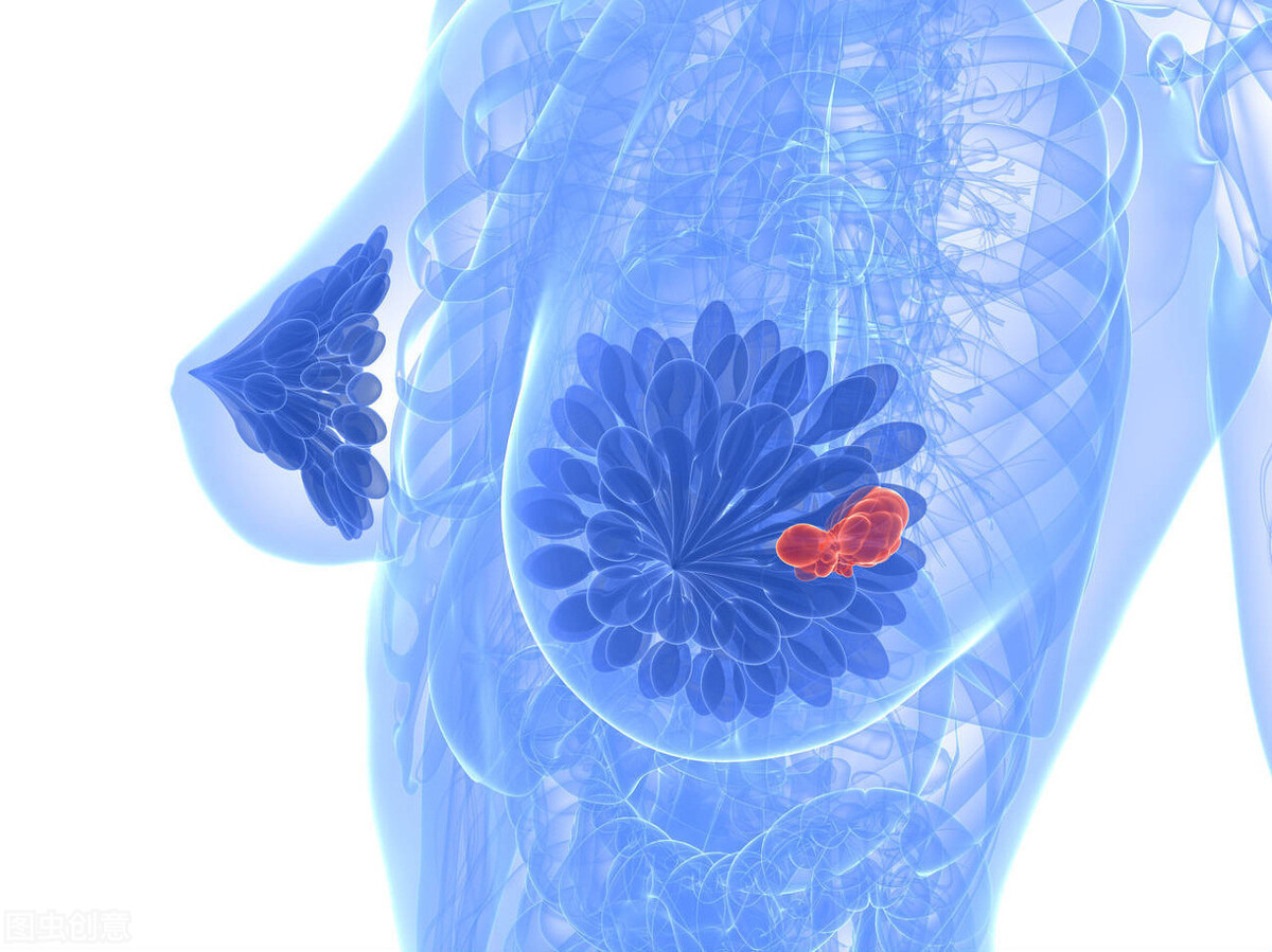 乳腺癌t1n2m0属第几期,原位导管乳腺癌0期