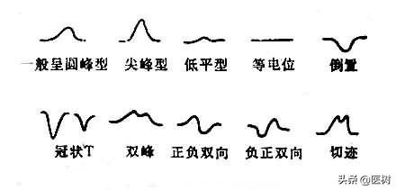 心电图t波改变是冠心病吗,心电图报告t波改变是冠心病吗