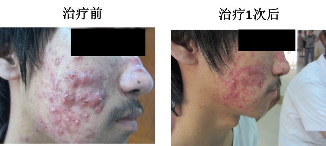 中医火针疗法教学视频,火针动手手法