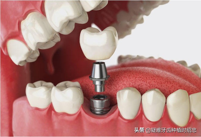 牙根拔出来好还是不拔好,拔牙根之前需求注意什么