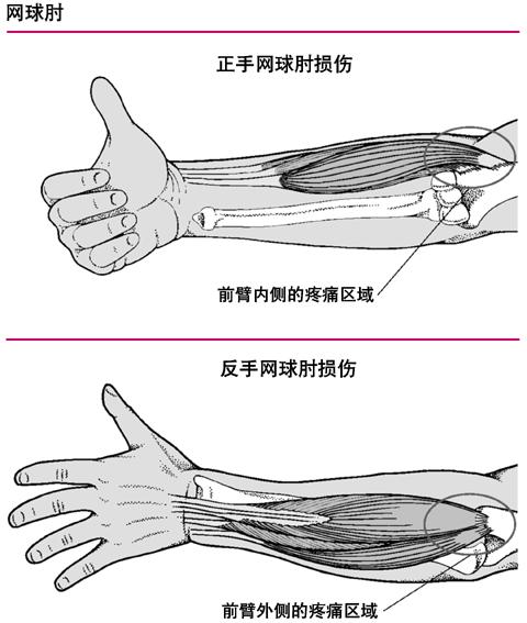 手肘忽然酸痛怎么缓解,手肘酸痛怎么办最快解决方法