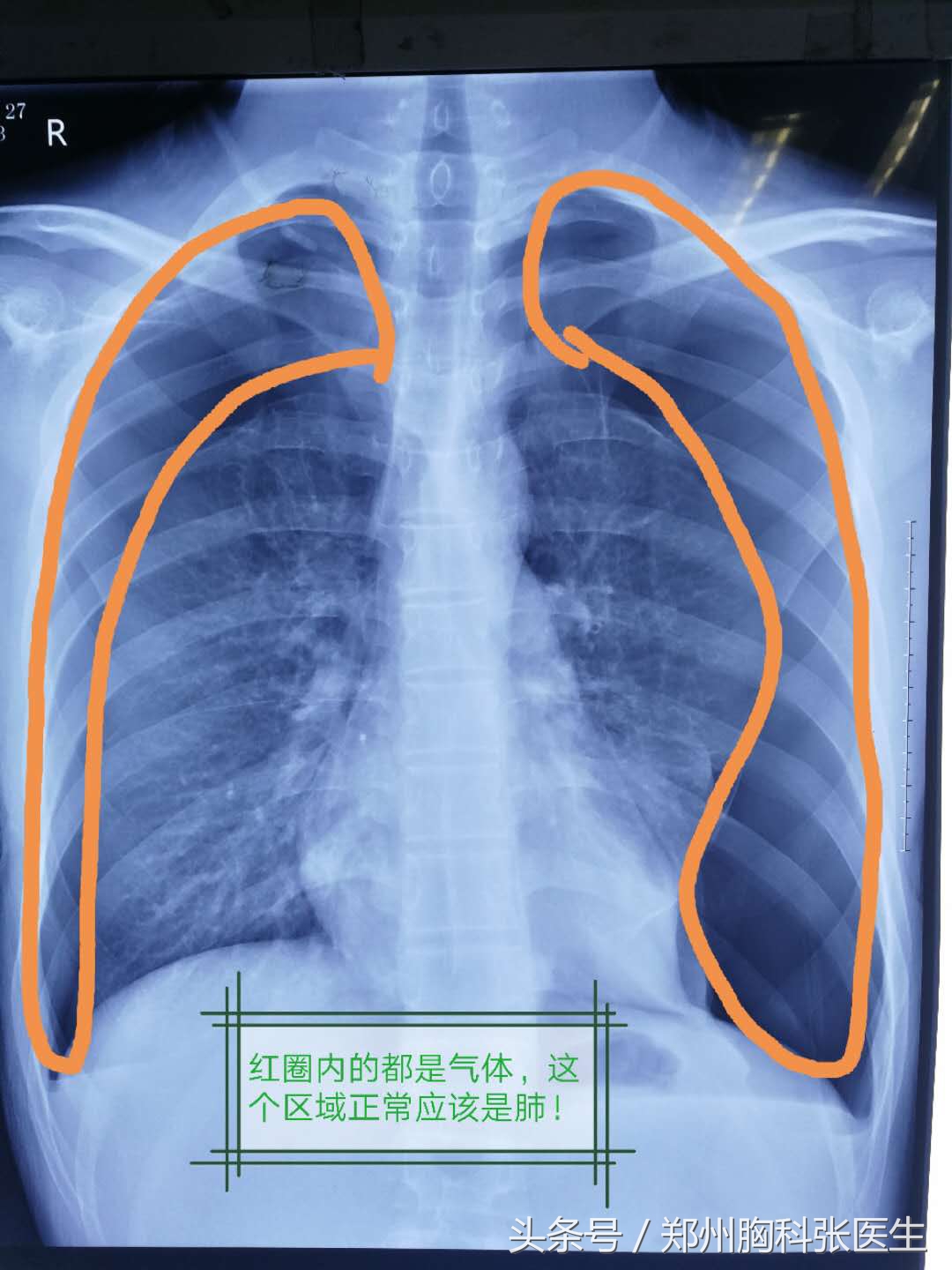 专家讲解关于气胸的知识,如何预防气胸一定要注意这四点