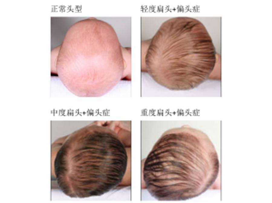 宝宝偏头怎么办？懂得的妈妈都这样做