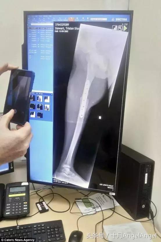 孩子说大腿疼是长个子么,小孩长个子腿的哪个部位疼