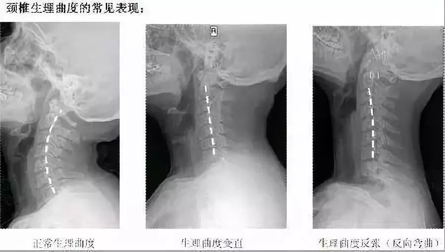 脊柱生理曲度变直的原因,脊柱生理曲度变直为什么还是驼背