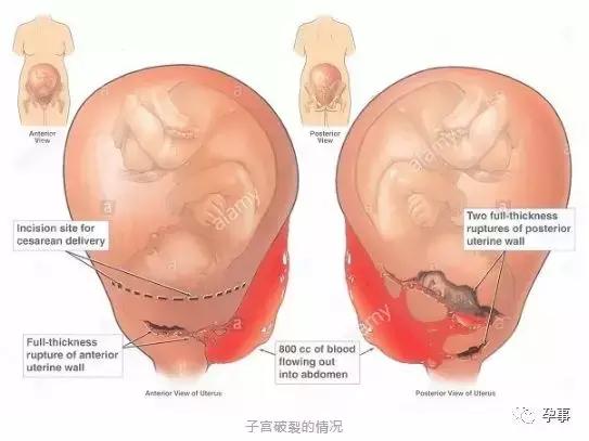 分娩痛算什么？这个妈妈子宫破裂，11.6斤“巨婴”掉进肚子！